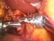 Closure of common bile duct perforation